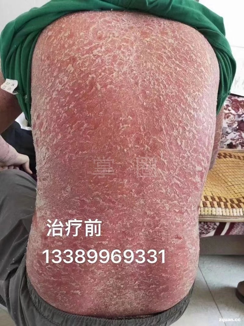 牛皮癣专科