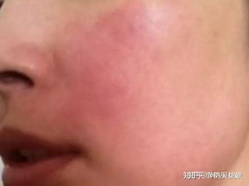 湿疹医院:选择专业的力量