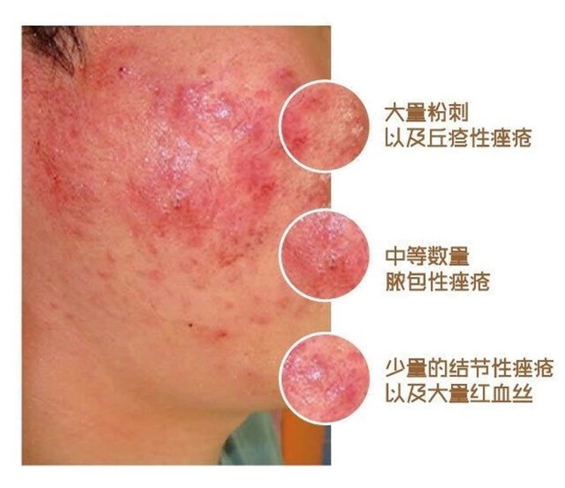 痤疮治疗